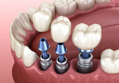 Dentysta Warszawa implanty